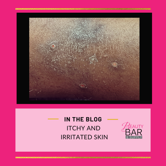 Living with Eczema: How Absolutely Shea Souffle Body Butter Can Help