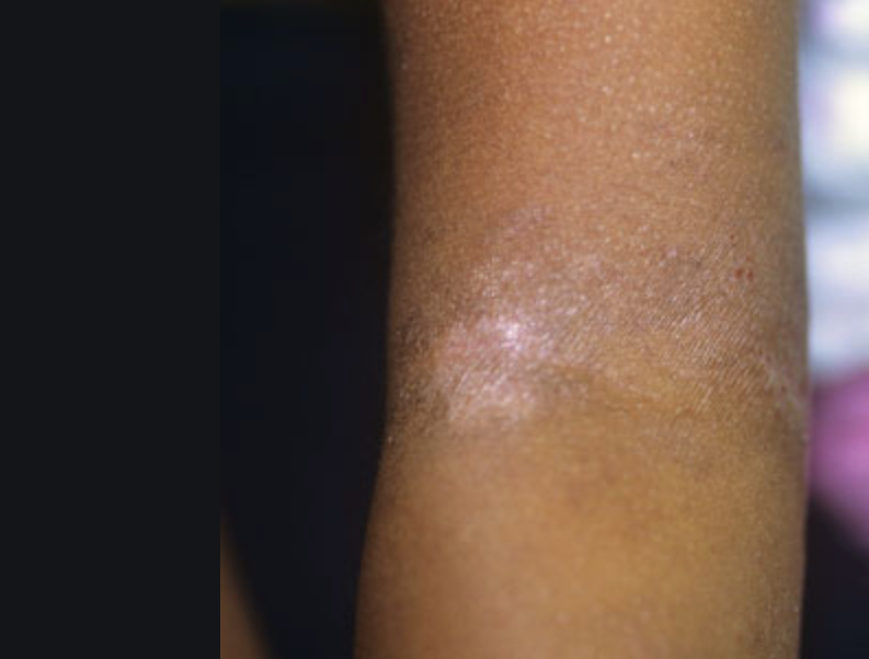 Brown skinned individual showing Eczema on the arm. 